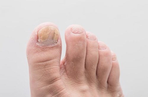 Remove Toenail Fungus With Bleach1