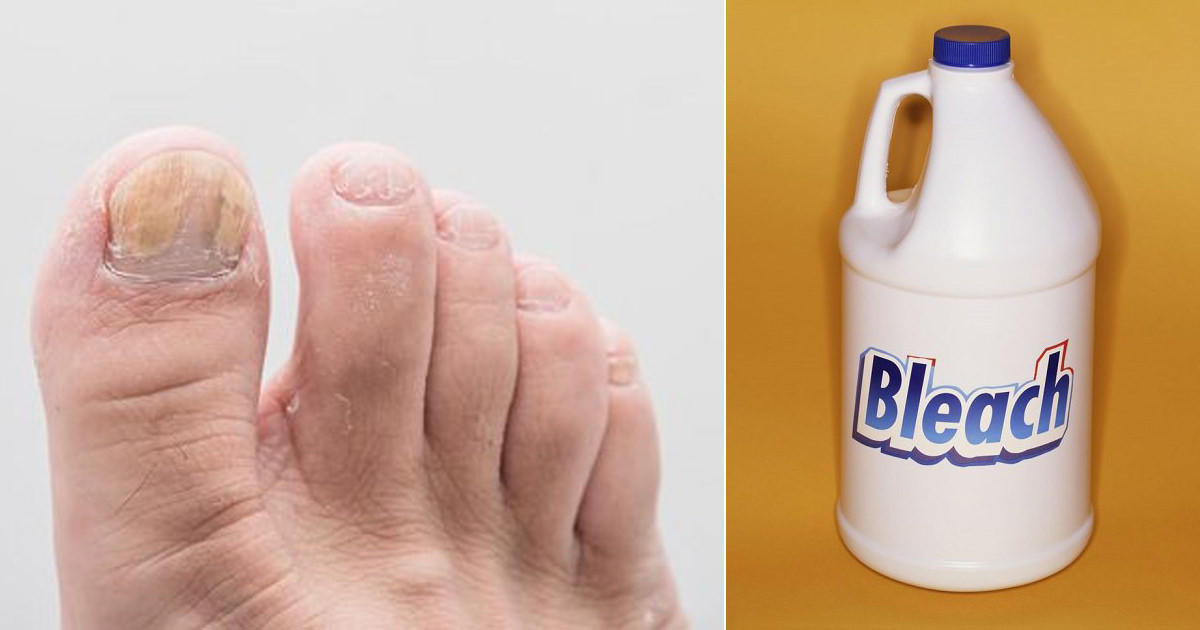 Clorox Bleach Kills Toenail Fungus Nail Ftempo