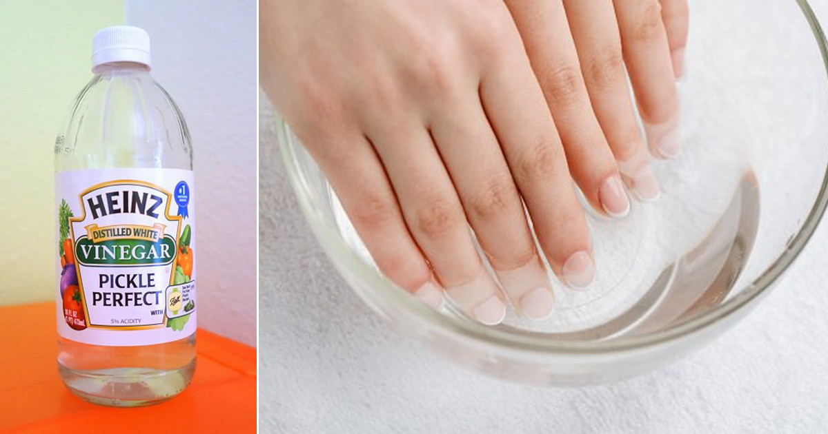 How to Whiten Nails With Vinegar | Causes and Other Ways How to Whiten Nails With Vinegar | Causes and Other Ways