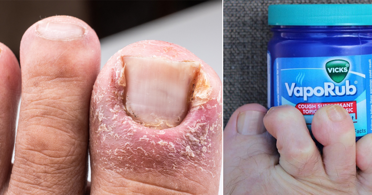 Vicks Vapor Rub Toe Nail