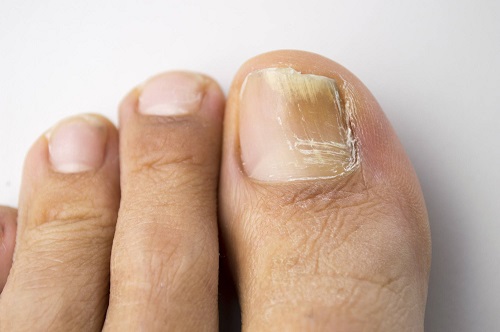 How to Get Rid of Toenail Fungus With Vicks1
