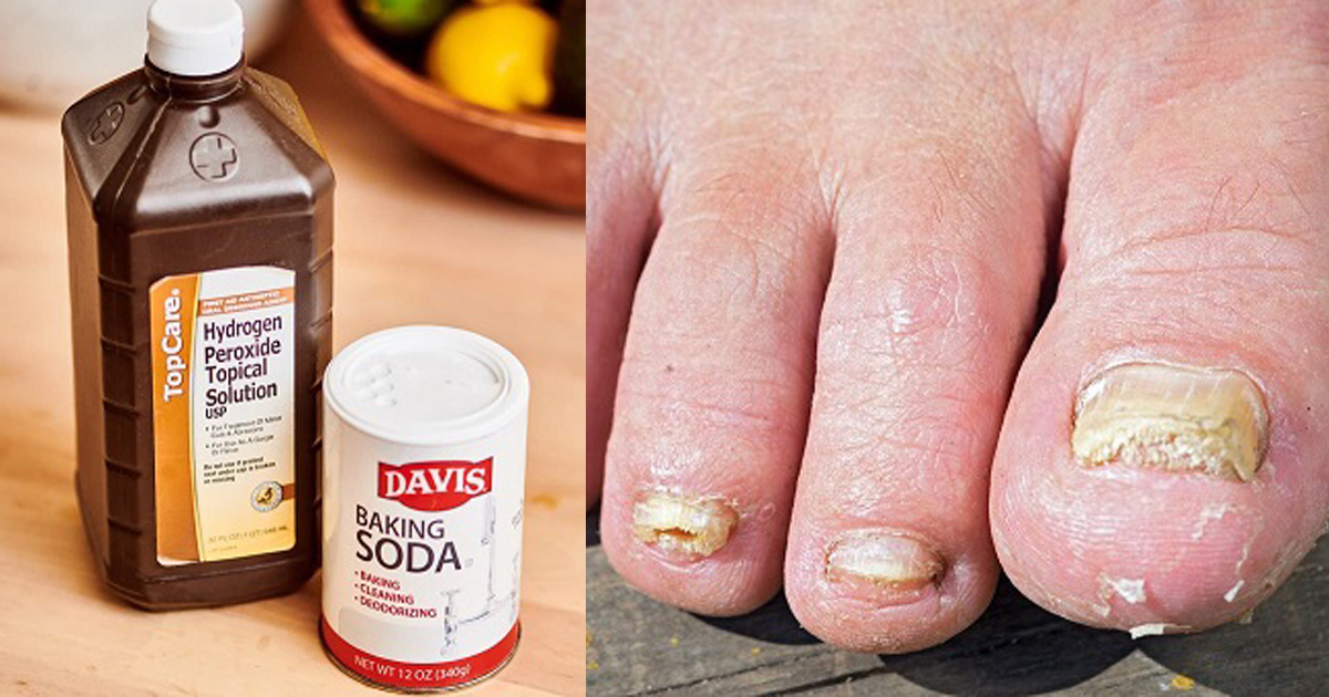 Baking Soda and Hydrogen Peroxide for Toenail Fungus | Home Remedies
