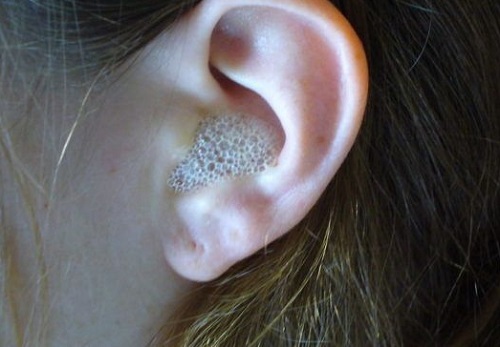 Hydrogen Peroxide for Clogged Ear2