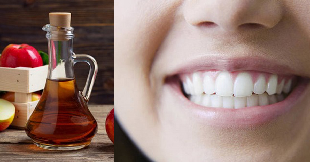 Is Apple Cider Vinegar Bad For Teeth And Oral Health Hello Lidy