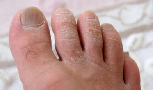 Can Coconut Oil Cure Toenail Fungus 