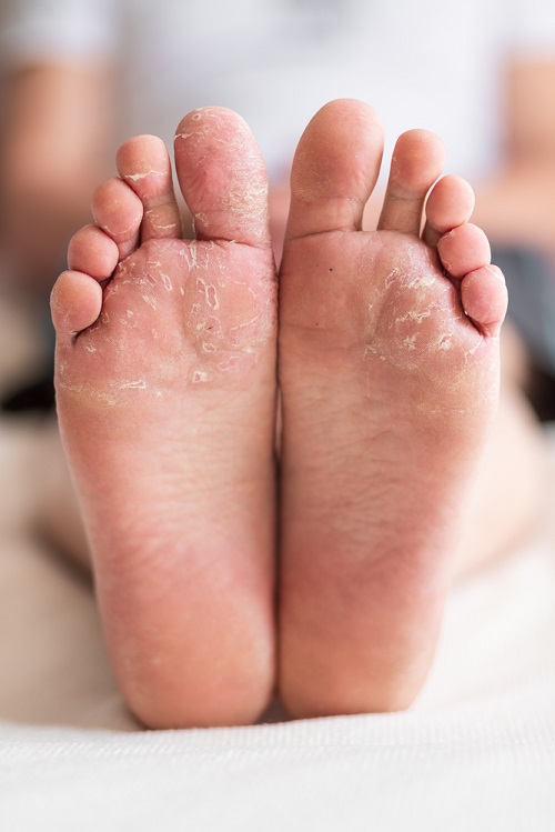 Essential Oils for Foot Fungus 1