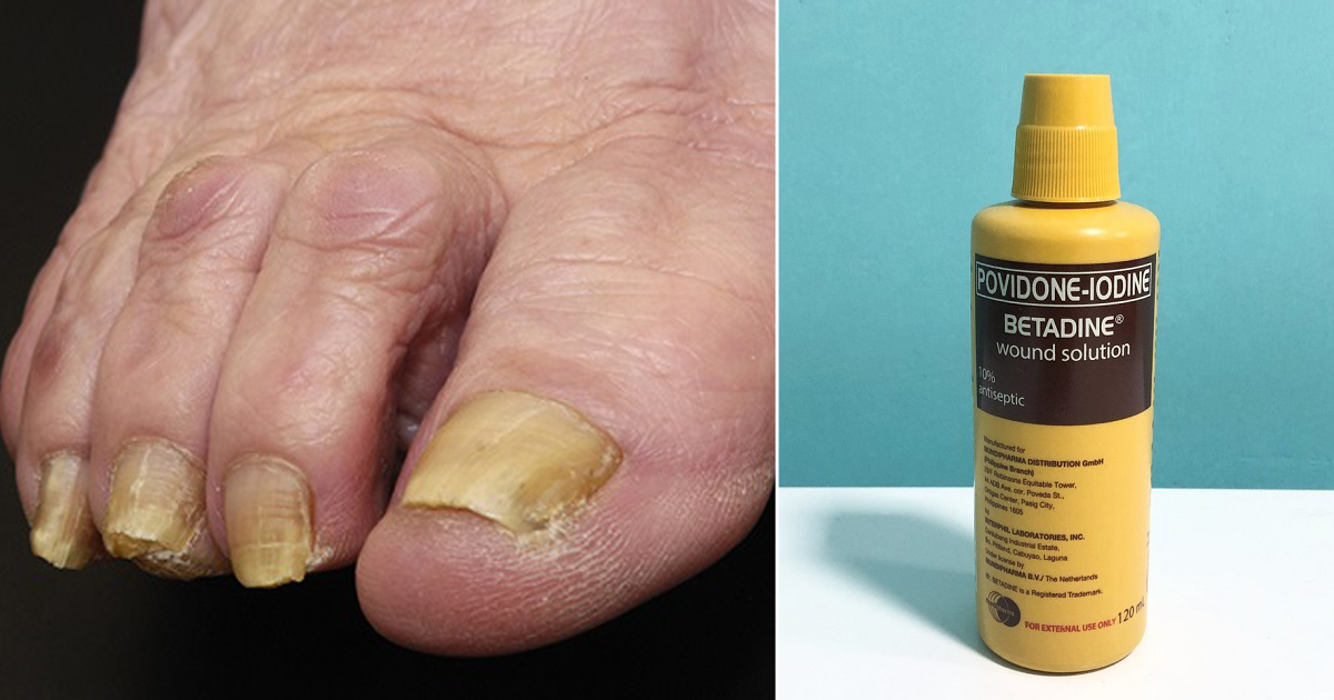 Povidone Iodine Solution For Toenail Fungus Bios Pics