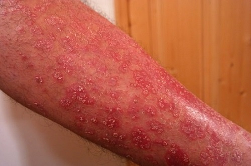 Treatment Of Psoriasis